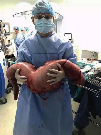 Médicos removem intestino com 15 Kg de fezes de homem com prisão de ventre crônica